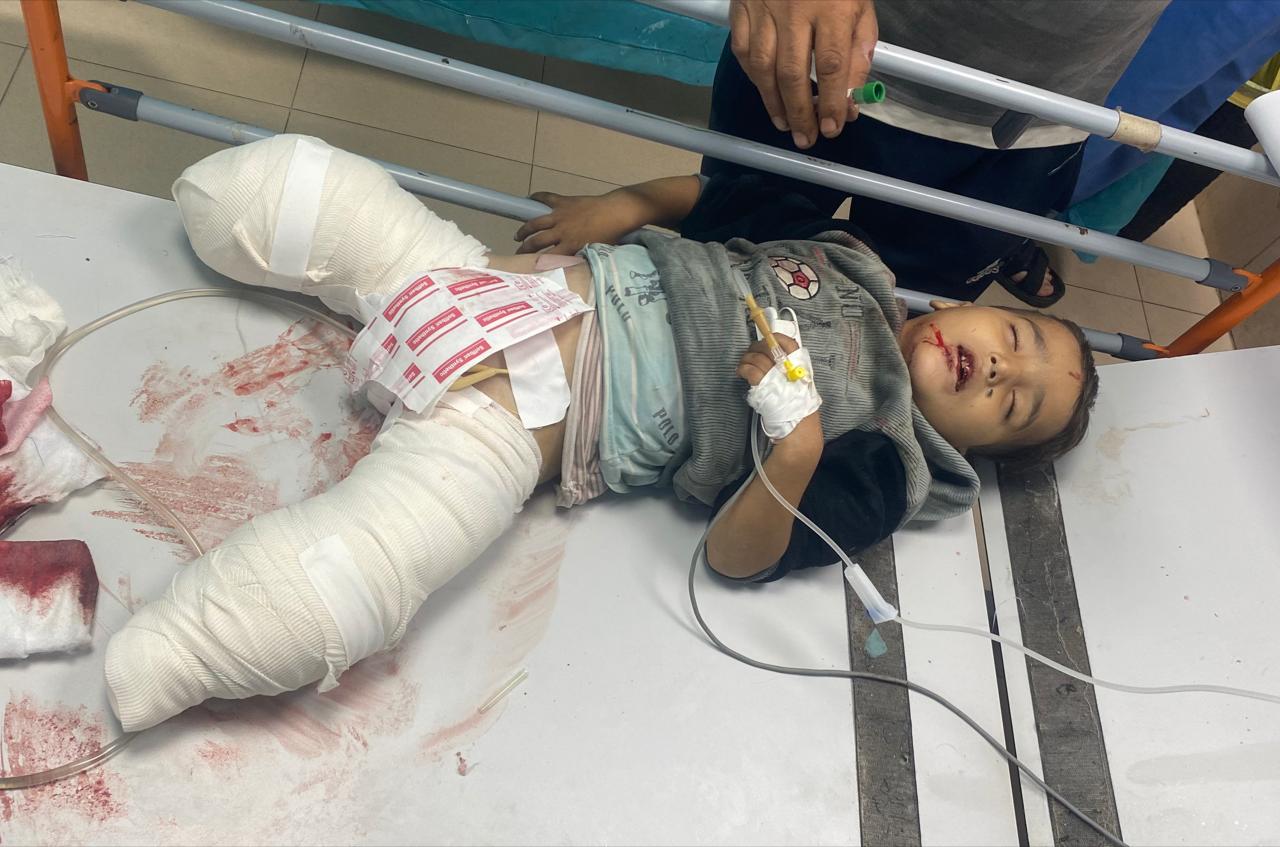 الطفل أحمد شبات (4 سنوات) فقد ساقيه جراء غارة جوية إسرائيلية على مواطنين في مخيم النصيرات مساء اليوم